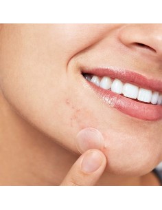 Пачове при акне с чаено дърво, 36 бр. 2