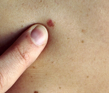 Безплатни прегледи за рак на кожата 