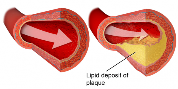 Как да се избавите от артериалната плака за 30 дни