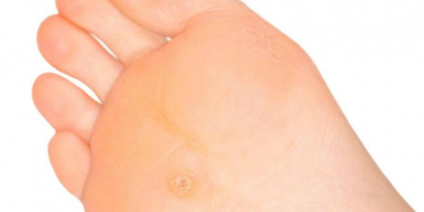 Край на досадните мазоли!