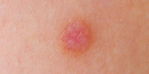 Брадавици: какво представляват и кога са опасни?