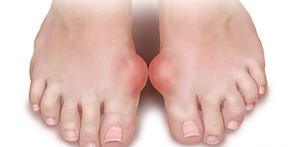 Как да се справите с подаграта?