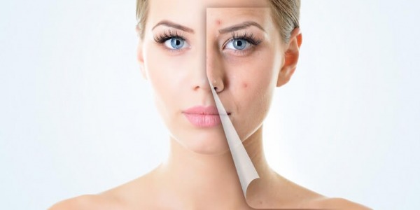 Акне: причината може да е в инсулина!