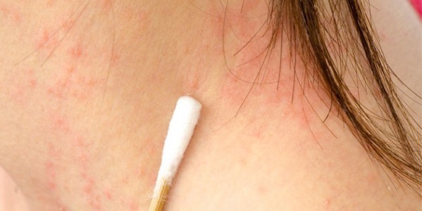 Пикногенол: отлично природно средство и срещу псориазис!