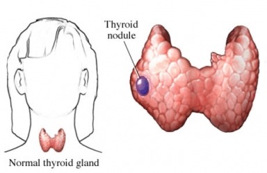 Възли на щитовидната жлеза