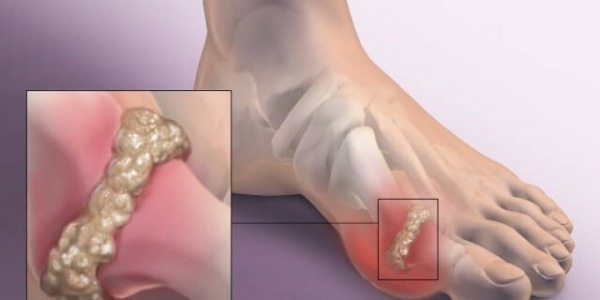 Витамин В5 - от полза в борбата с подаграта!