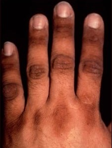 Акантозис нигриканс