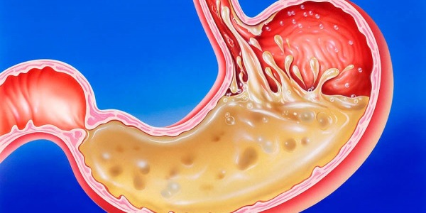 Стомашни киселини – има нови и ефикасни методи на лечение!