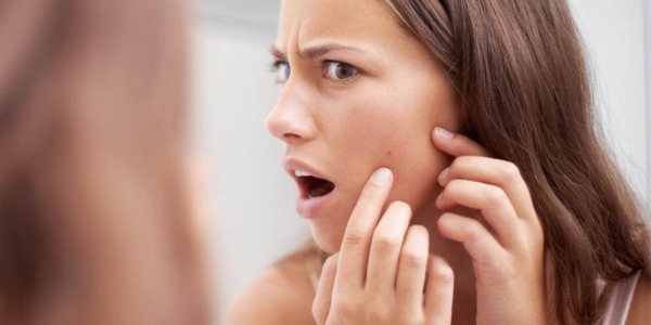 Акнето – лечим проблем или проклятие за цял живот?