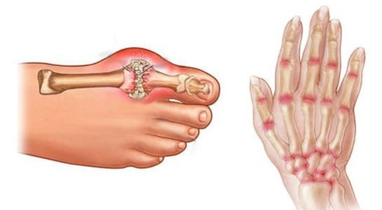 Ето кои са най-работещите начини да се справите с артрита!