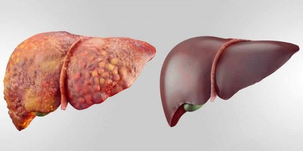 Супер детоксикация на черния дроб в 5 лесни стъпки!