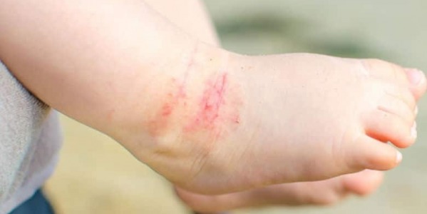 Пробиотиците – полезни и при атопичен дерматит!