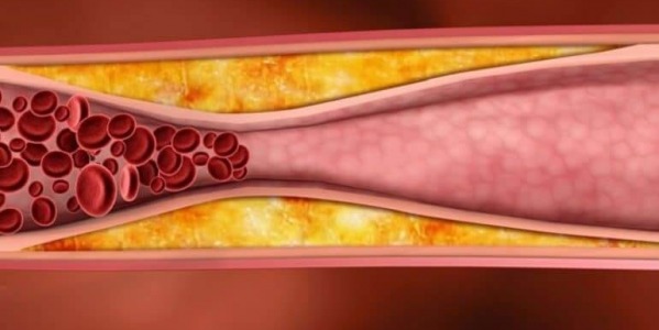 Топ 5 природни средства срещу висок холестерол