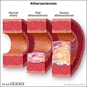 Атеросклероза  (профилактика)