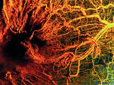 Синдром на Чърг-Щраус