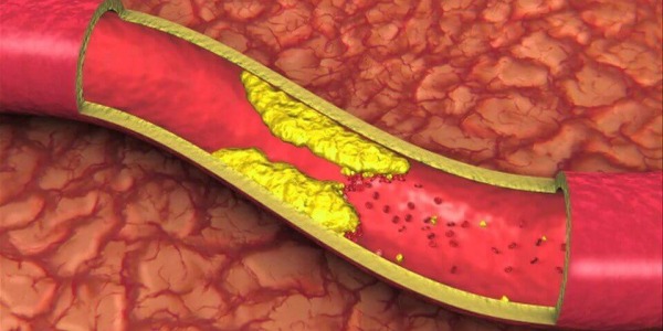 Витамин К2 намалява риска атеросклероза, инфаркт и инсулт