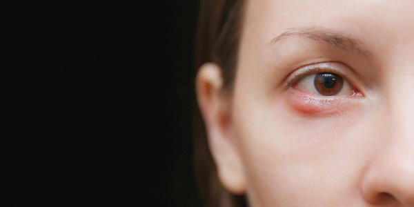 Ефикасни домашни средства при ечемик на окото