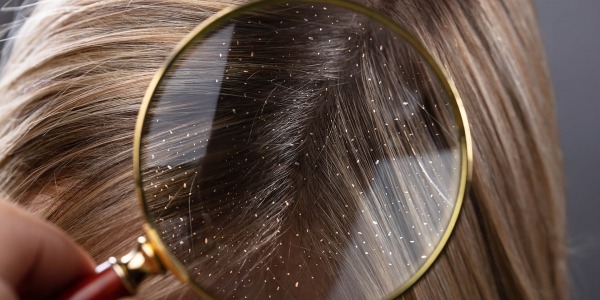 Пърхотът -  от какво се причинява и можем ли да го избегнем?