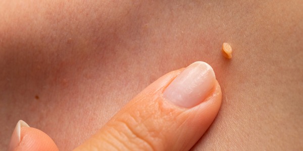 Папилома вирус – какво трябва да знаем за него